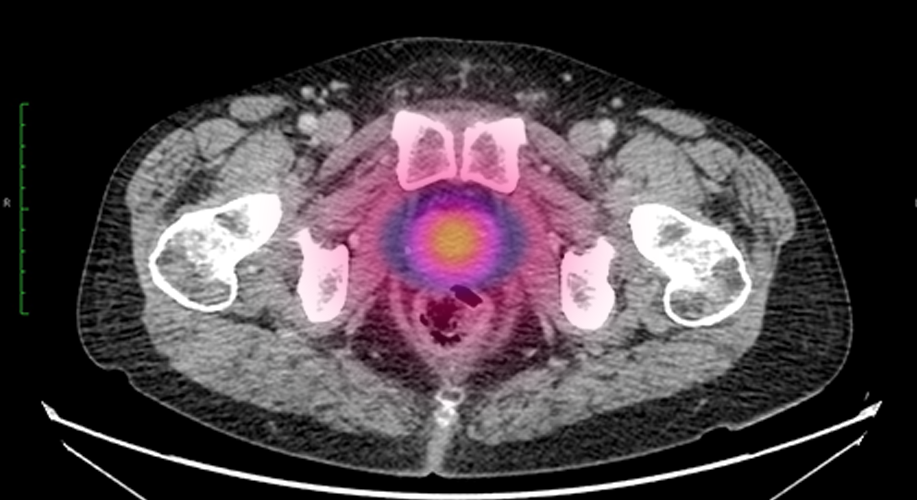 La radioterapia adaptativa en línea reduce potencialmente la toxicidad para el tratamiento del cáncer de próstata de alto riesgo.