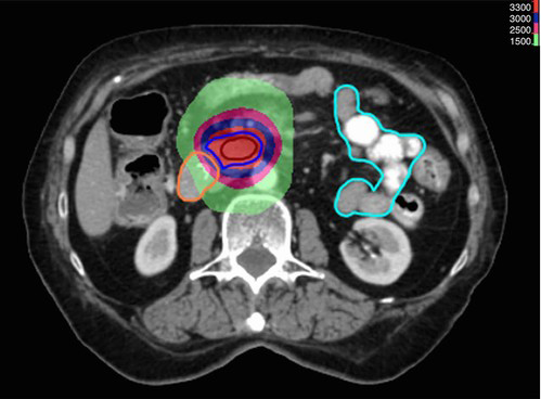 Radioteràpia hipofraccionada d'intensitat modulada amb quimioteràpia concurrent per a pacients ancians amb carcinoma de pàncrees localment avançat.