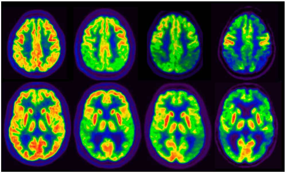 Valor diagnóstico de PET-amiloide y PET-Tau: una comparación cara a cara.