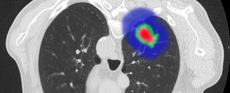 Viabilidad de la radioterapia hipofraccionada en pacientes con (CPNM) con ganglios positivos inoperables con factores de pronóstico precario y reserva pulmonar limitada: un estudio observacional prospectivo.