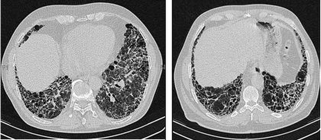 Tomografía computarizada de tórax personalizada(Niveles mínimos de dosis de radiación diagnóstica para la detección de fibrosis, nódulos y neumonía).