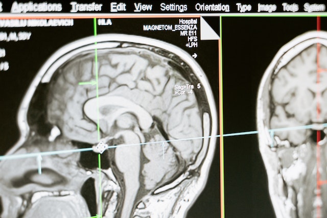 Imatge de seqüència SPACE 3-D T1 isotròpica dedicada per a radiocirurgia la planificació millora la detecció de metàstasis cerebrals i redueix el risc de recaiguda intracranial.