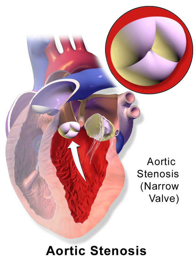 Impacto de la función ventricular sistólica derecha en pacientes con estenosis aórtica.