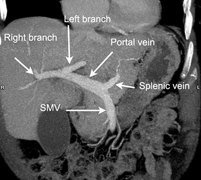 Reducción de la dosis de radiación y mejora de la calidad de imagen en la venografía portal por TC mediante 80 kV y la reconstrucción iterativa estadística adaptativa ASIR-V en pacientes delgados.