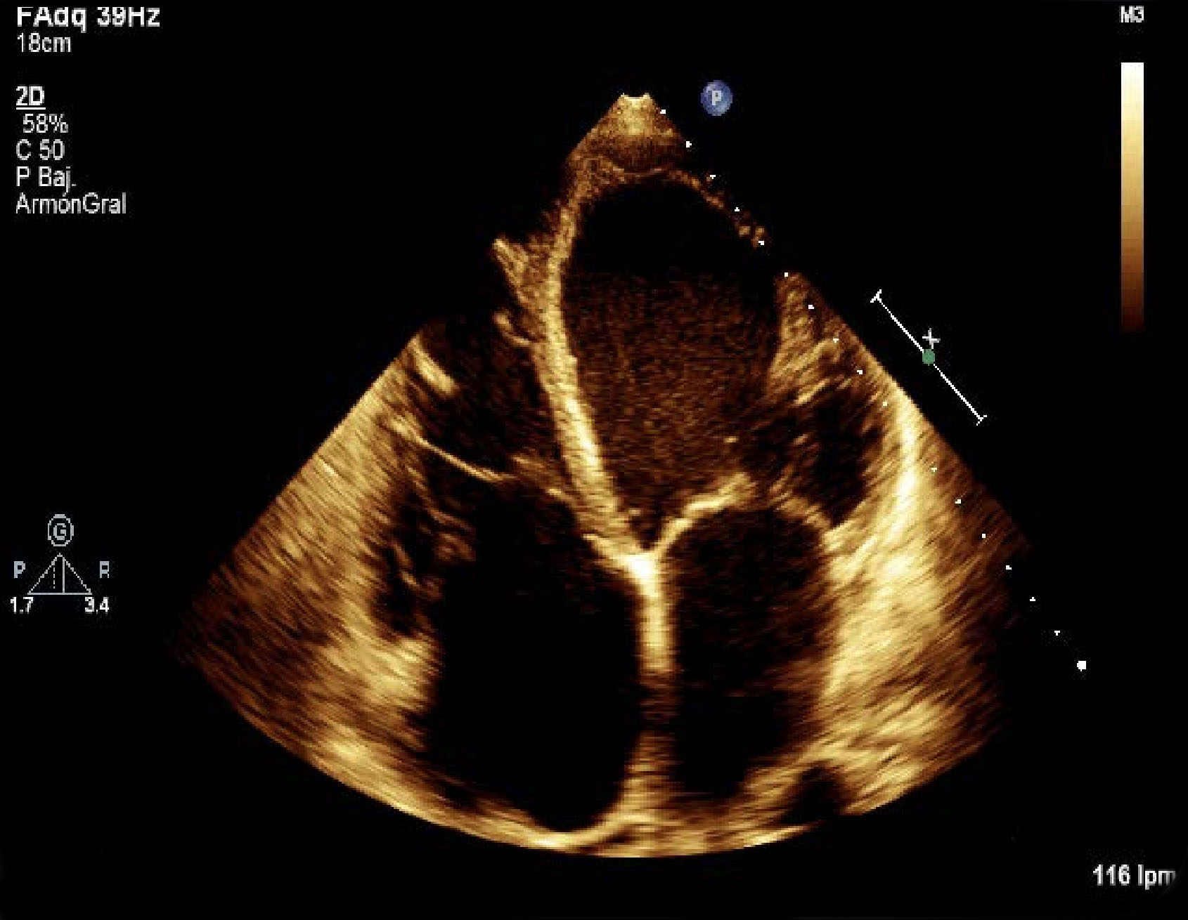 Implicación pronóstica del índice de rigidez auricular izquierda en pacientes con insuficiencia cardiaca con fracción de eyección preservada.