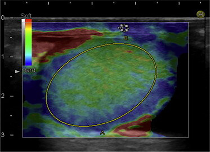 Evidència radiològica de dany testicular en casos de Coronavirus de la Síndrome Respiratòria Aguda Greu 2. Un potencial rol de la sonoelastografia.