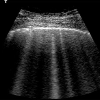 ¿Qué nos encontramos en la Ecografía Pulmonar durante la pandemia COVID-19?