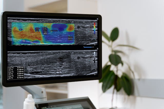 Movimiento longitudinal y rigidez de los nervios de la extremidad inferior medidos con ecografía y elastografía en población asintomática y sintomática: Revisión sistemática y metaanálisis.