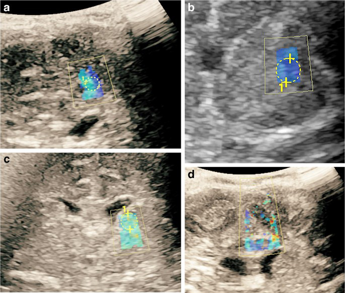 Viabilitat i reproductibilitat de l'ecografia per shear wave en ecografia cerebral pediàtrica.