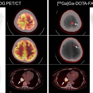 Comparación entre [68Ga]Ga-DOTA-FAPI-04 y [18F] FDG PET/CT para el diagnóstico de lesiones primarias y metastásicas de distintos tipos de cáncer.