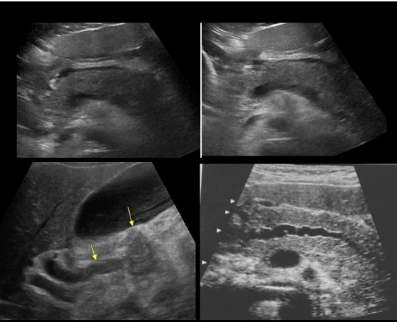 Utilidad de los ultrasonidos en la pancreatitis aguda