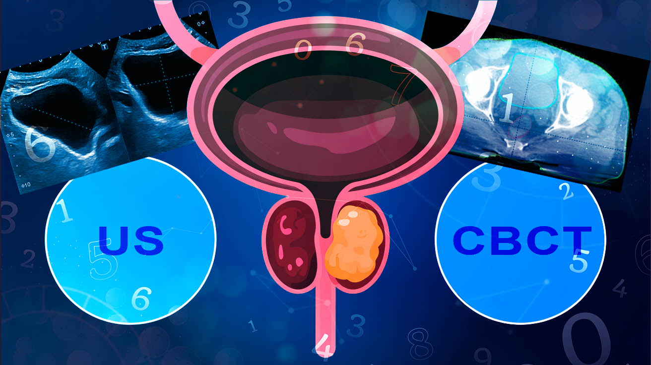 Evaluación crítica de un estudio prospectivo de la evaluación del volumen de la vejiga mediante ultrasonido en la radioterapia del cáncer de próstata: Comparación con la tomografía computarizada de haz cónico (CBCT).
