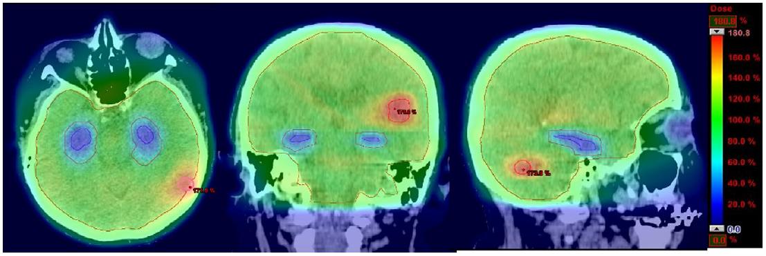 Protección del hipocampo durante la radioterapia en pacientes con metástasis craneales. Estudio comparativo entre RDT holocraneal con protección del hipocampo más memantina y RDT holocraneal más memantina.