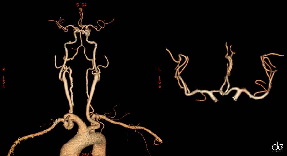 Estudi de la variabilitat d'intensitat d'opacificació, per contrast, en estudis d'accidents cervell vasculars aguts mitjançant angiografia per tomografia computada en centres especialitzats i atenció inicial als Estats Units.