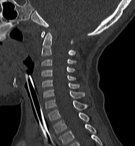 Lesions de la columna cervical pediàtrica en TC: diferència en la precisió de les interpretacions per part de radiòlegs pediàtrics enfront de radiòlegs no pediàtrics.