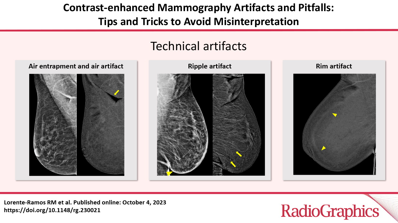 Artefactos y Pitfalls de la mamografía con contraste: Consejos y trucos para evitar interpretaciones erróneas.