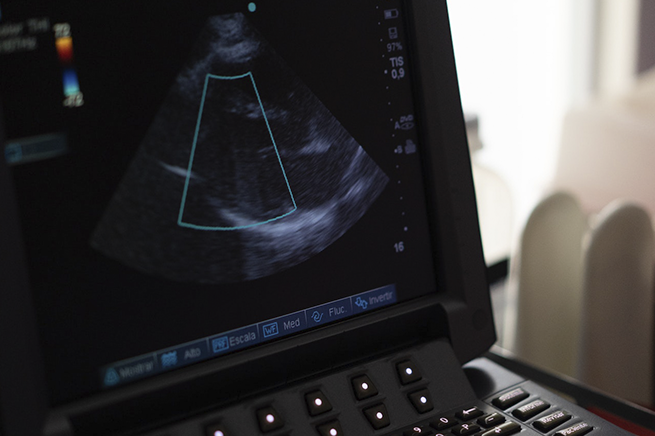 Congestió pulmonar durant l'ecocardiograma d'estrès en pacients amb insuficiència cardíaca.