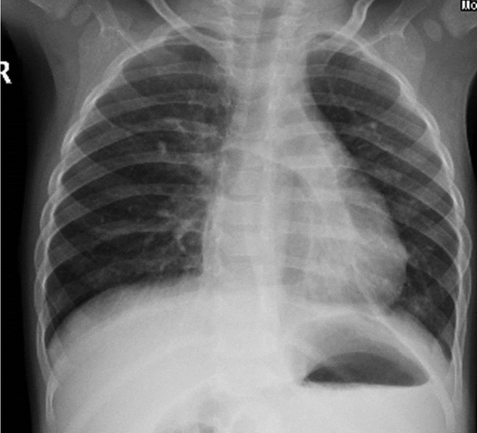 Estudi per a la modificació dels paràmetres en la radiografia de tòrax mitjançant un maniquí toràcic neonatal.